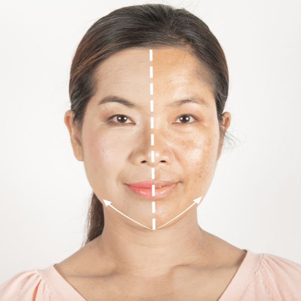 Professional facial rejuvenation device treating mature skin