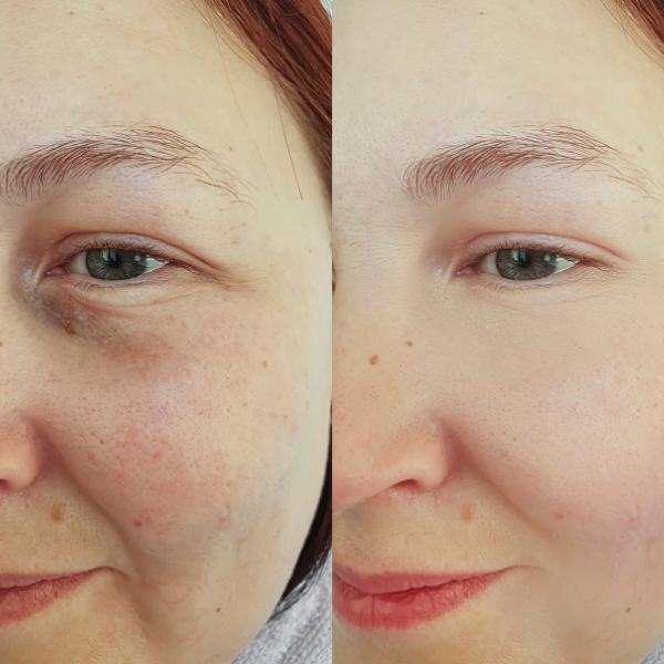 Before and after client photos demonstrating results of professional LED skincare treatment.